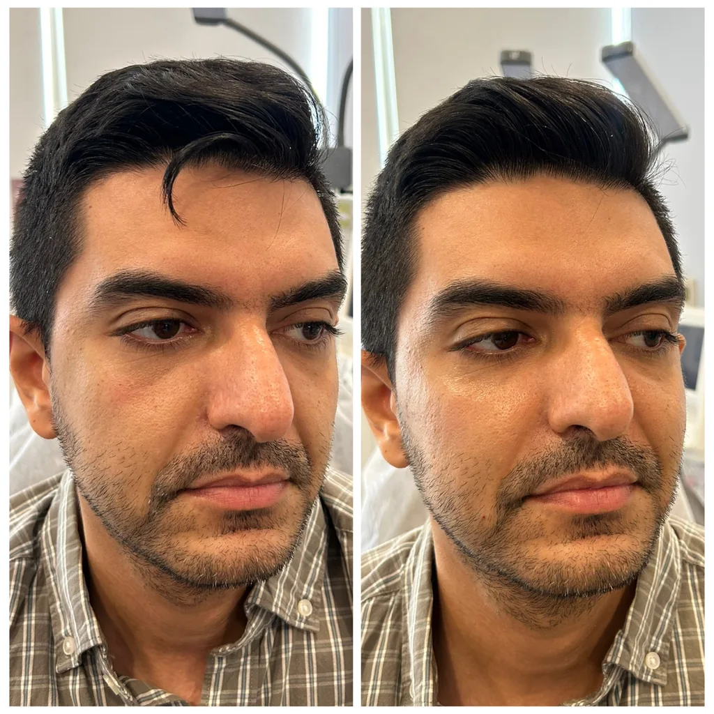 Mid-cheek filler before and after in Dubai by Dr. Azra Vaziri — mid-face support restored in a male patient, before (left) and after (right)