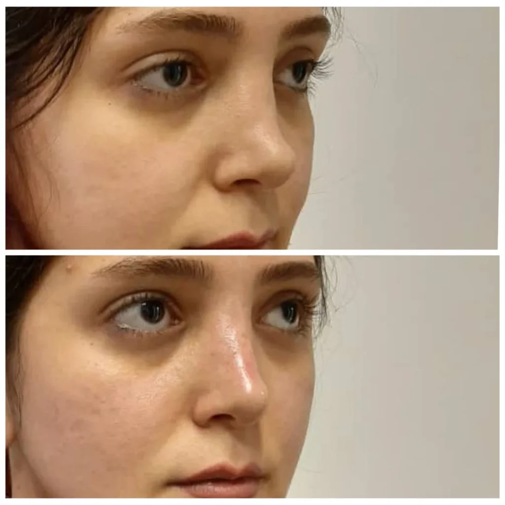 تجميل الأنف بالفيلر قبل وبعد في دبي مع د. عذرا وزیری — انسيابية أفضل لظهر الأنف