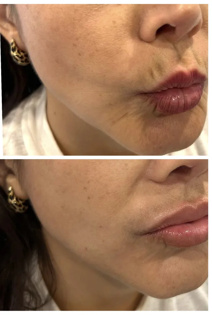 Smoker’s lines Botox before and after in Dubai by Dr. Azra Vaziri — vertical lip lines softened, before (top) and after (bottom)