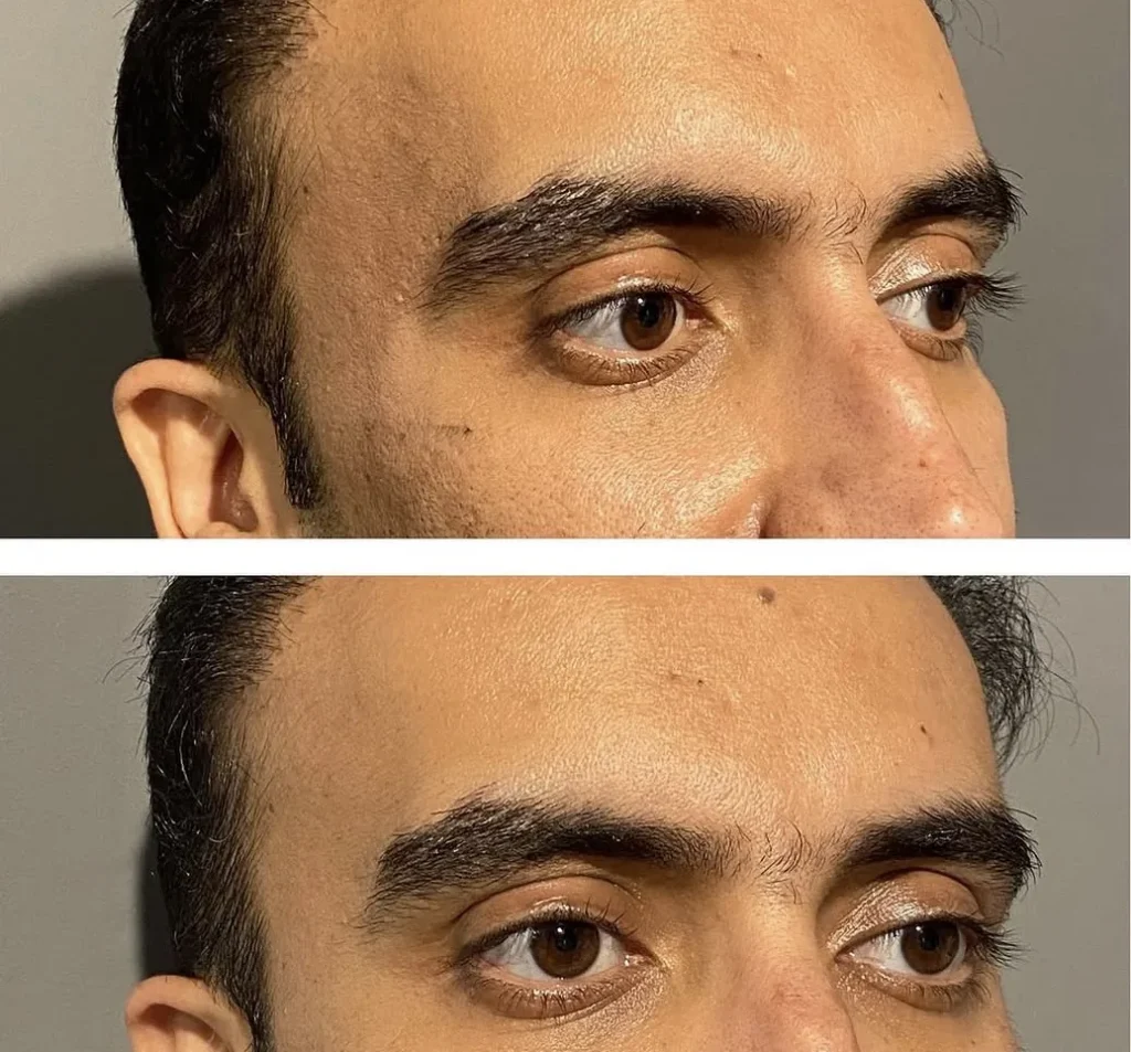 Temple filler before and after in Dubai by Dr. Azra Vaziri — hollow temples restored, before (top) and after (bottom)