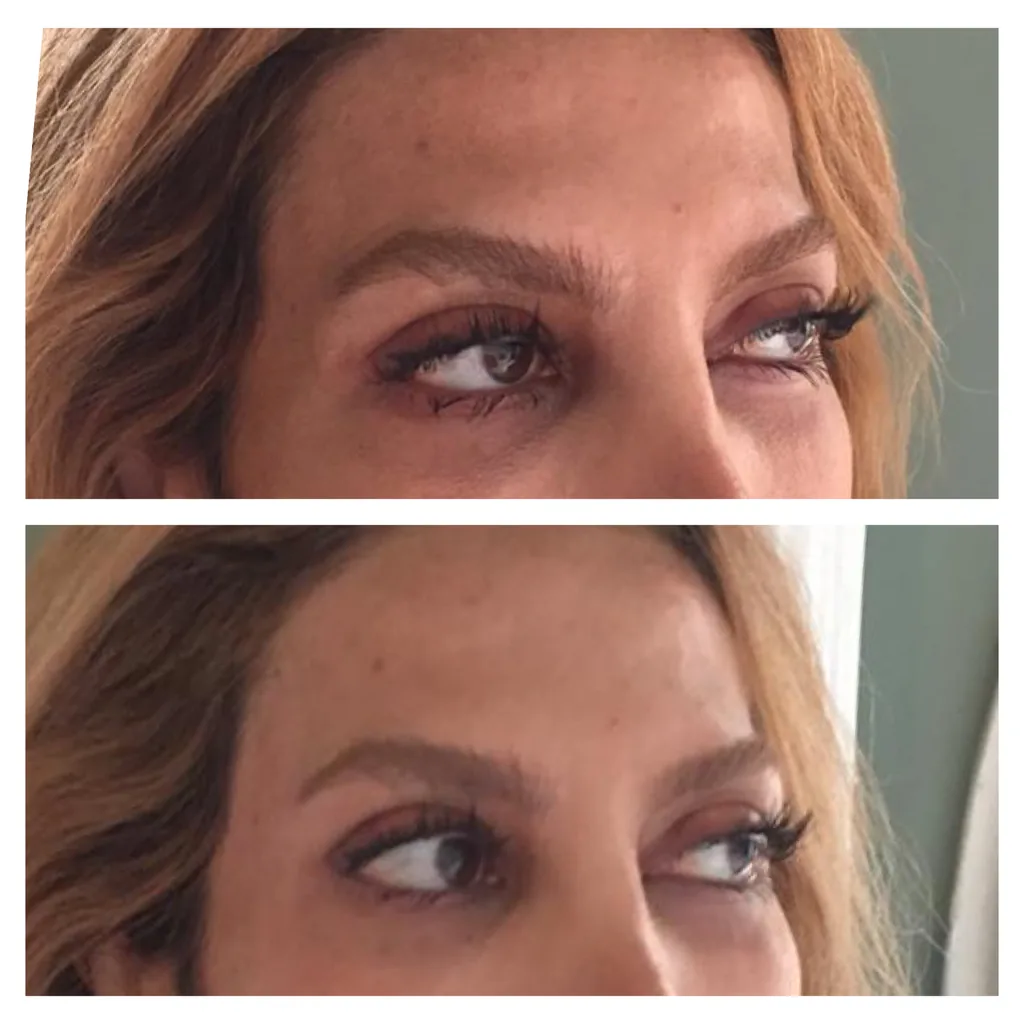 Temple filler before and after in Dubai by Dr. Azra Vaziri — temple hollow filled and the brow tail supported, before (top) and after (bottom)
