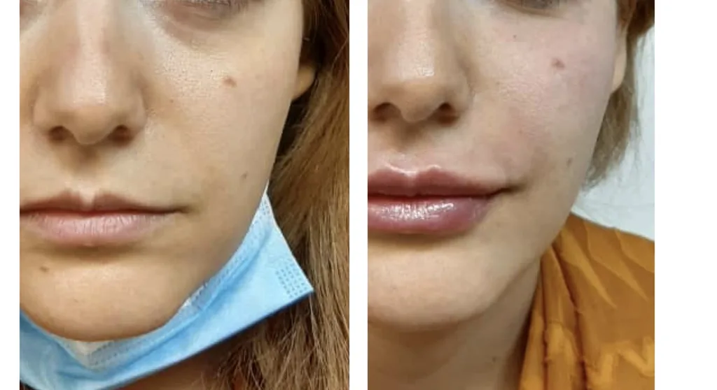 Under-eye, mid-cheek and lip filler before and after in Dubai by Dr. Azra Vaziri — a rested, balanced face, before (left) and after (right)